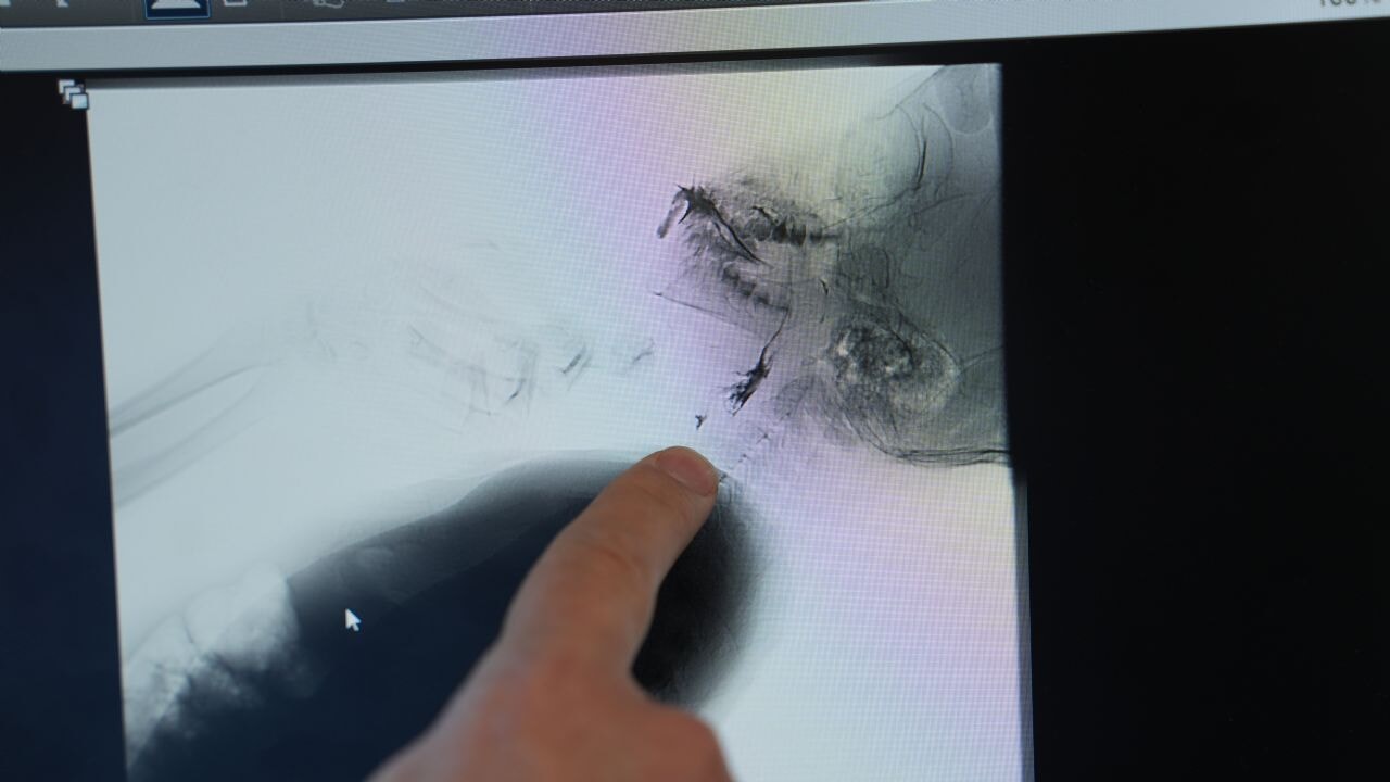 Yutma bozukluğu hangi hastalarda daha sık görlüyor?