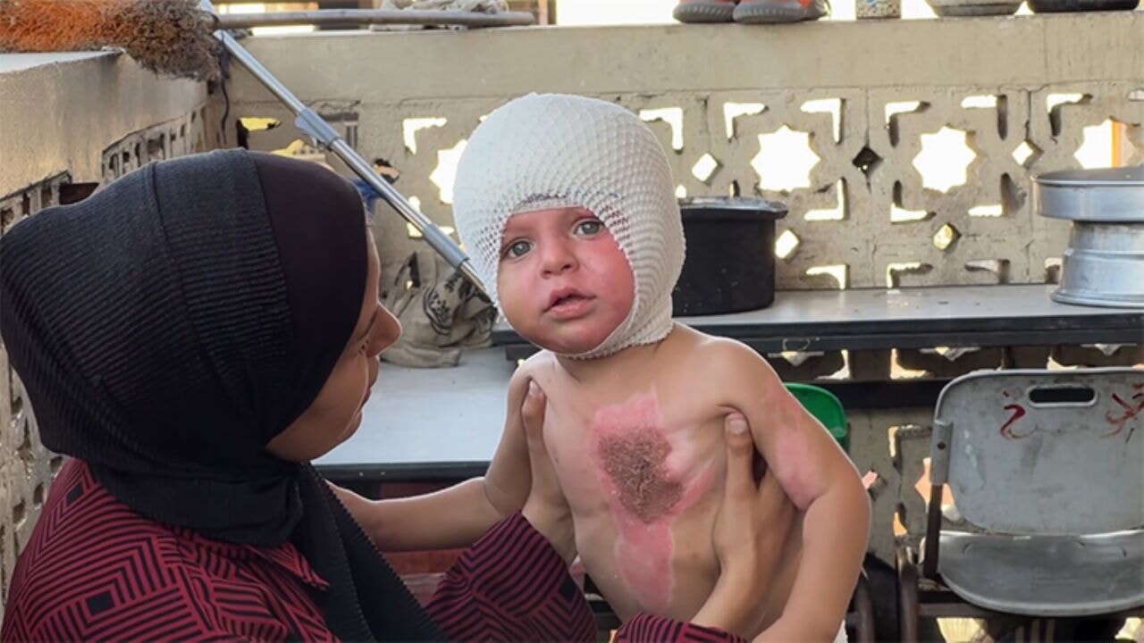 İsrail saldırısında ağır yaralanan Gazzeli Ramiz bebeğin dramı