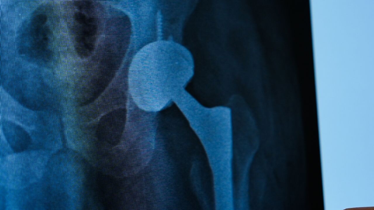 Dört yıllık ağrılı yaşam tek ameliyatla bitti