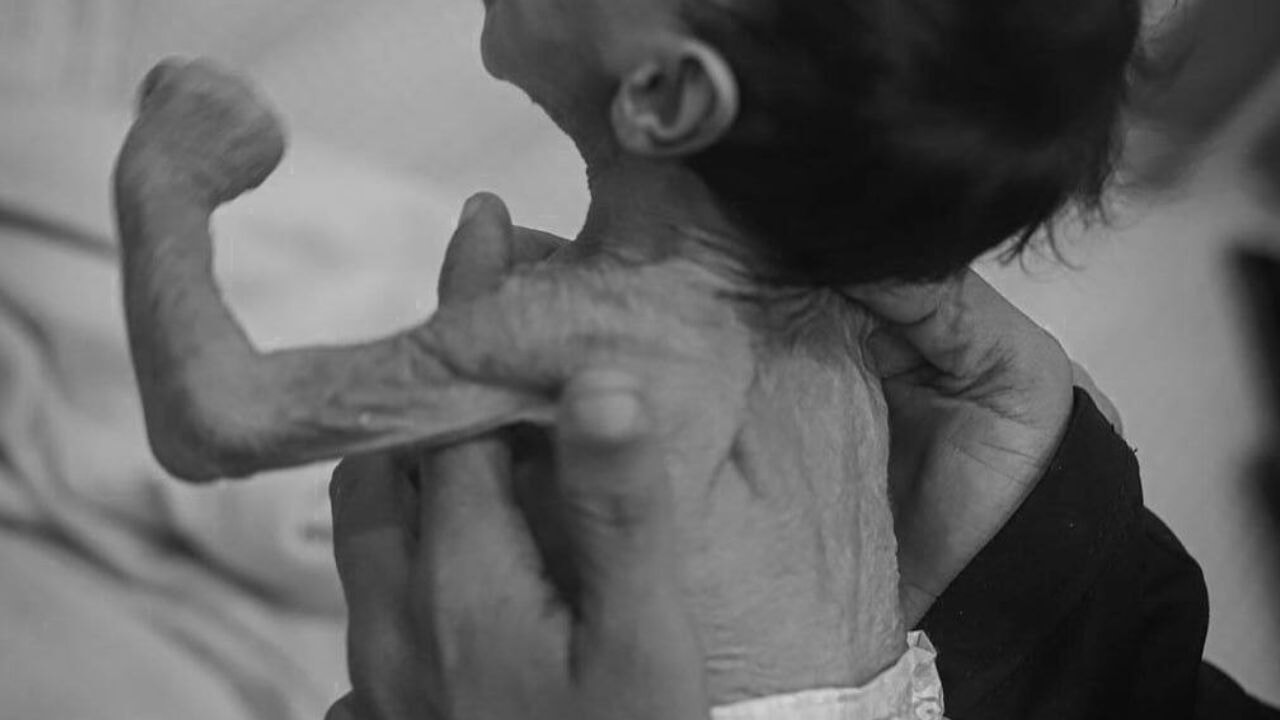 Gazze'de açlıktan şehit olanların sayısı 459 oldu!  Bunlar rakam değil, Müslüman kardeşin!