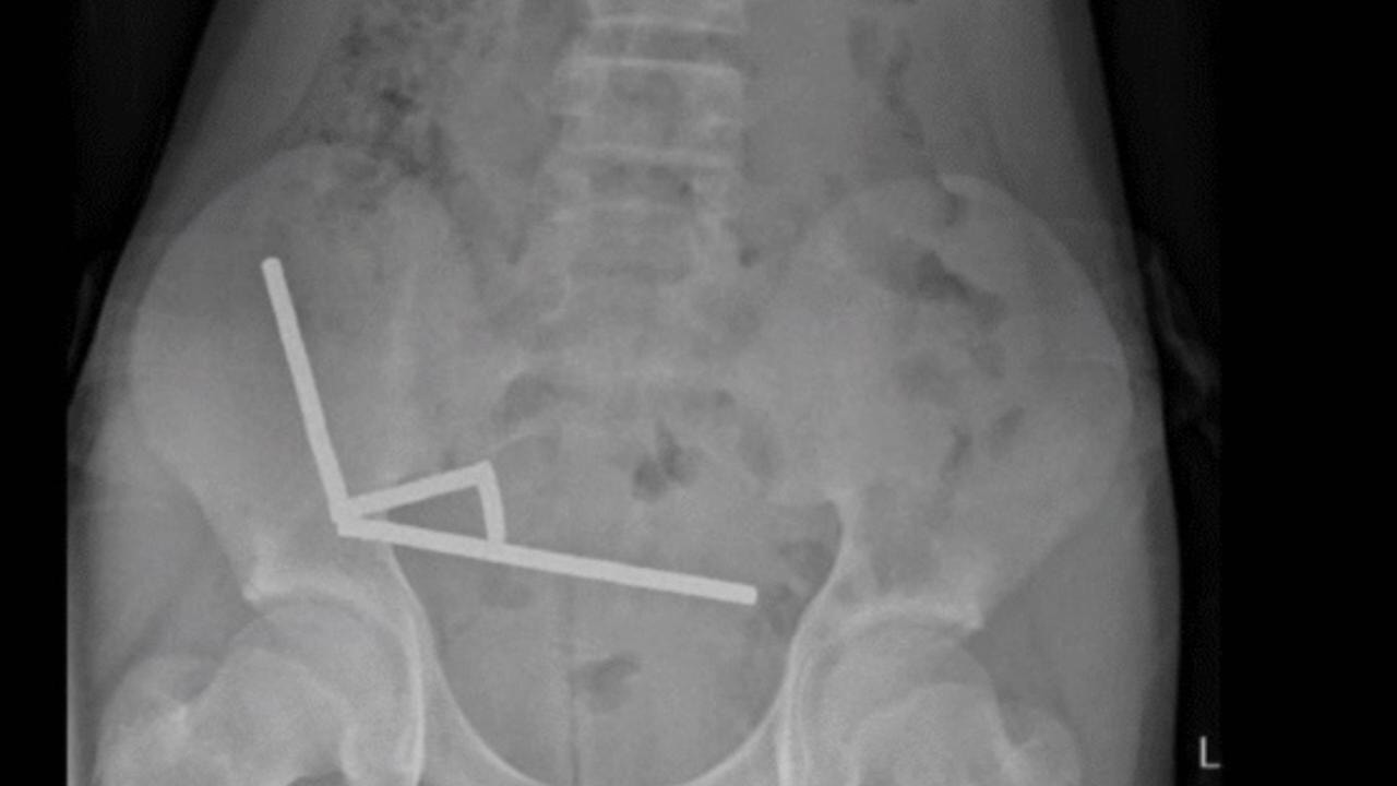 200 mıknatıs yuttu, bağırsaklarını kaybetti: Temu'dan açıklama