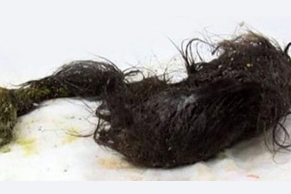 Midesinden 2 Kilo Saç Çıktı