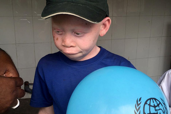 Afrika'nın beyaz insanları: Albinolar