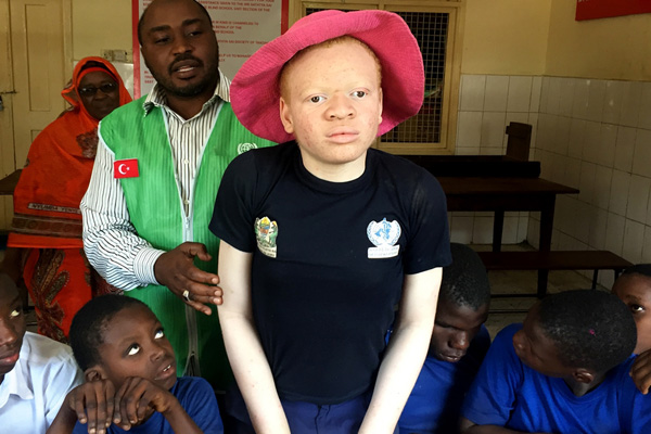 Afrika'nın beyazları Albinolar çok zor şartlarda yaşıyorlar