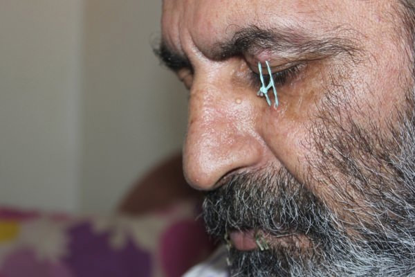 İranlı sığınmacı protesto için göz kapağını da dikti