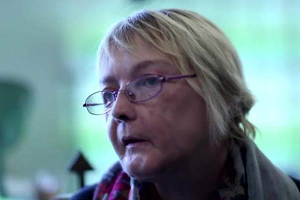 Dünyanın ilk yüz nakli yapılan insanı hayatını kaybetti