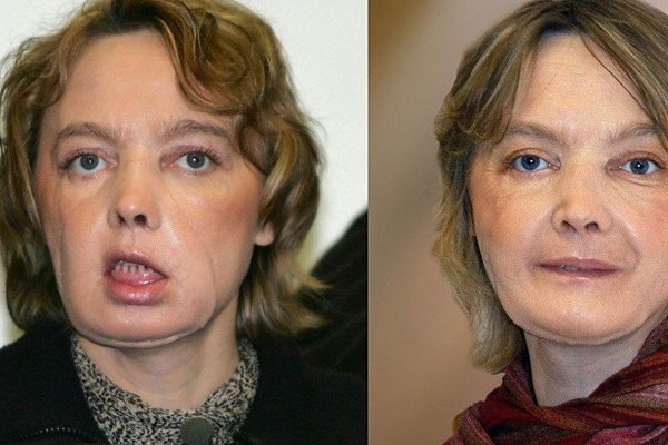 İlk yüz nakli yapılan hastası öldü