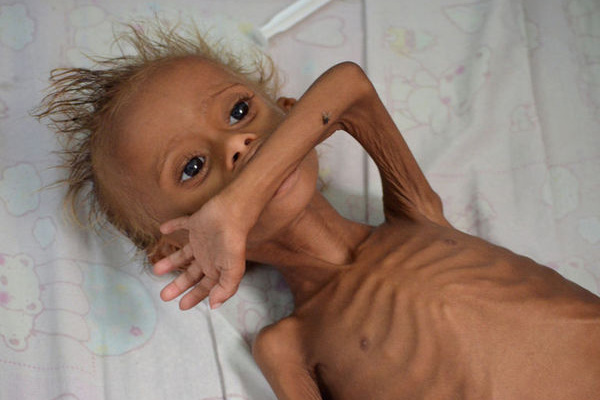 Yemen'deki savaştan yürek burkan kare