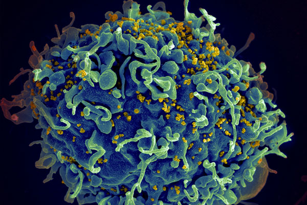 Doğuştan AİDS hastalarına umut