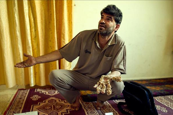 'Ağaç adam' 6 yıldır ameliyat edilmeyi bekliyor