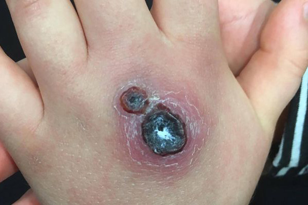 Örümcek ısırığı elinde delik açtı