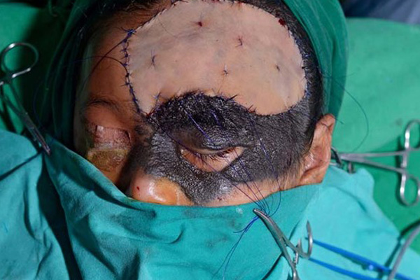 Minik kızın yüzünden saç çıkıyor