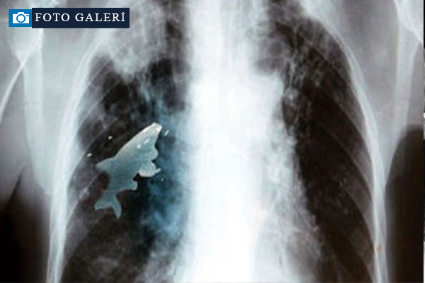 Şaşırtan röntgenler