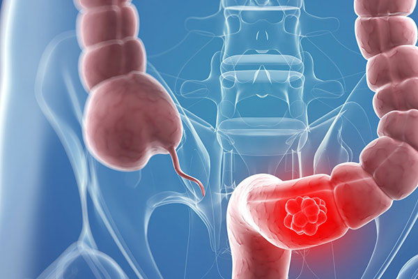 Kanserin nedeni bulundu