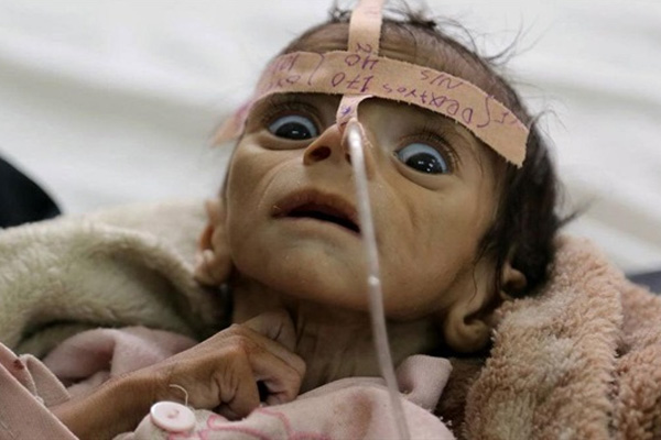 Yemen'de açlıktan ölüyorlar