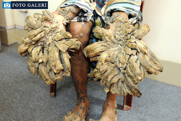 'Ağaç adam' tedavi oldu!