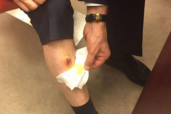 'Bacağımı CHP'li vekil ısırdı'