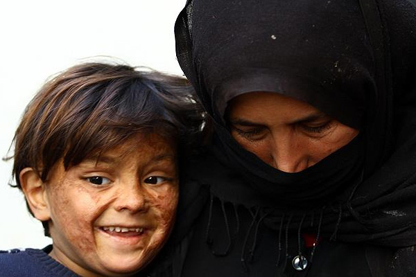 Minik Suriyeli savaşın izlerini yüzünde taşıyor