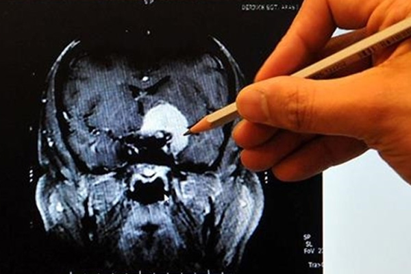 Beynin şekli kişilik farklarını belirliyor