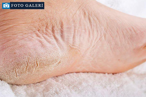 Topuk çatlamasına dikkat! Ölümcül bir hastalığın belirtisi olabilir