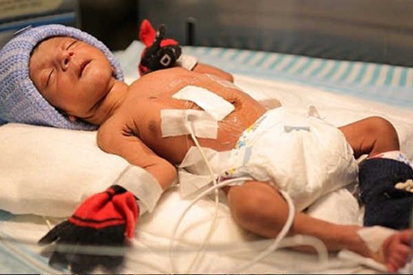 Hindistan'da dört ayaklı doğan bebek ameliyat edildi