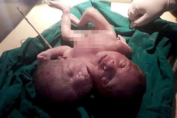 Hindistan'da çift başlı bebek doğdu!