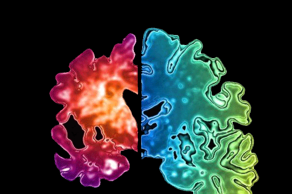 Alzheimer nasıl bulaşabilir?