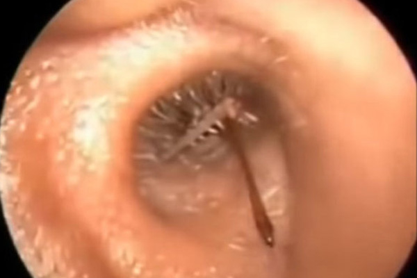 Kulağından öyle bir şey çıktı ki...