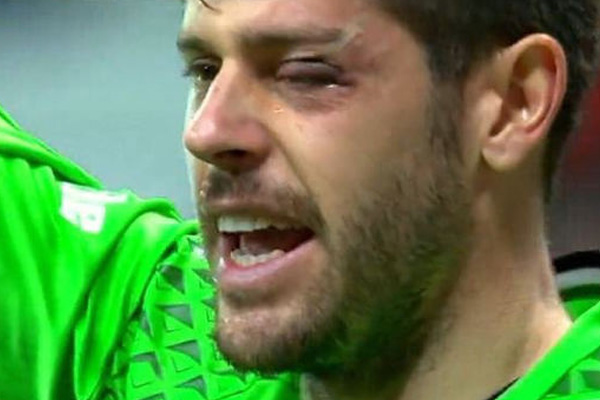 Fabri'nin gözü morardı!