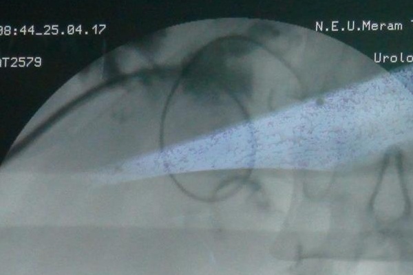 Karaciğer cerrahisinde 'Türk yazılımı' yanılgı payını azaltacak