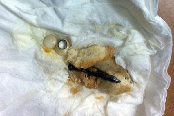 Pideden çıkan çivi 4 dişini kırdı