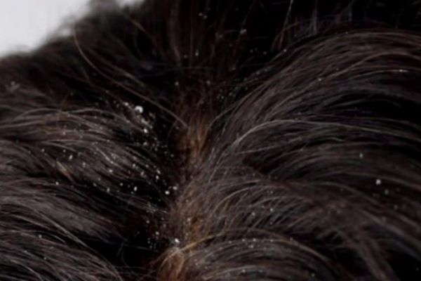 Doğal yollarla kepek problemine çözüm