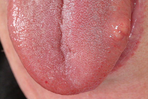 Dil felcinin belirtileri