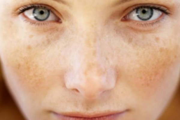 Cilt lekeleri için ne yapılmalıdır?