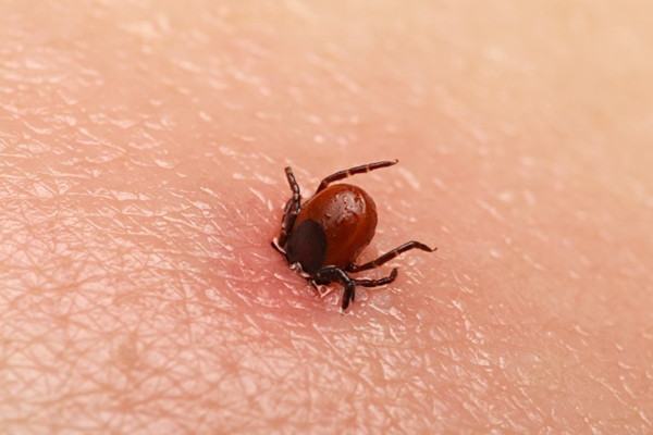 'Kene vücuttan bu şekilde çıkarılmamalı'