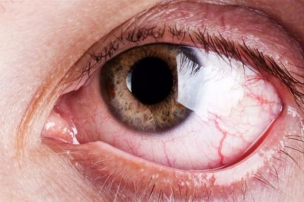Yaz ayında göz iltihaplanmasına uyarı