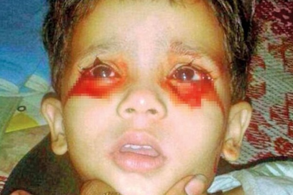 Bu çocuk kan ağlıyor