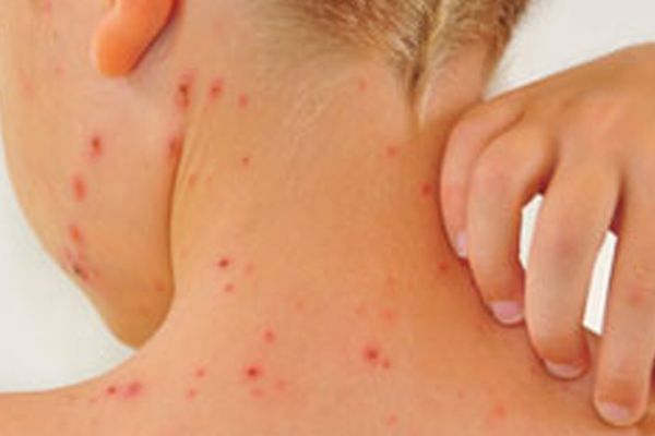 Avrupa'da kızamığa yakalanan 35 çocuk hayatını kaybetti