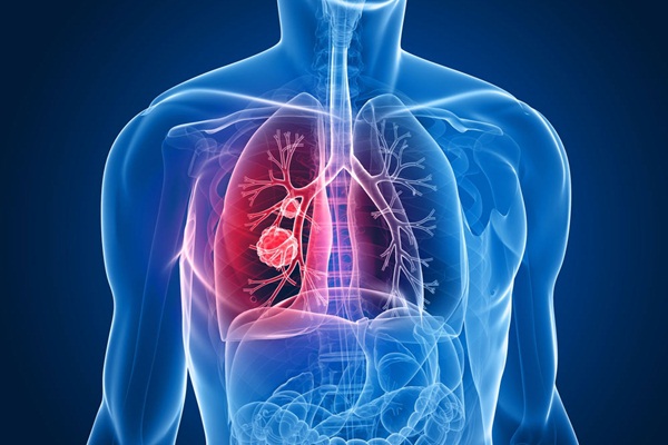 Akciğer kanseri aşısı Türkiye'de