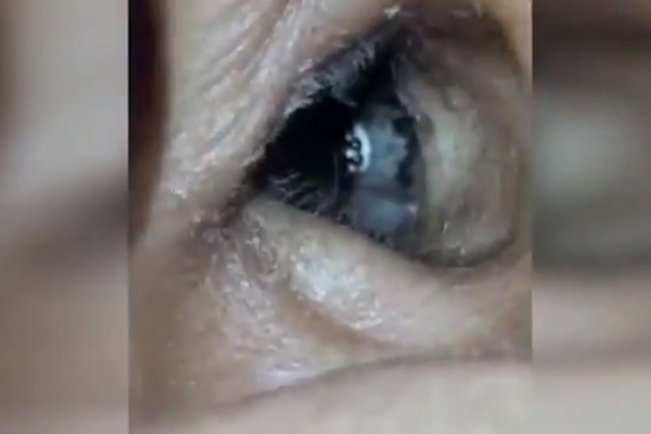 Baş ağrısı şikayetiyle doktora gitti, kulağından örümcek çıktı!