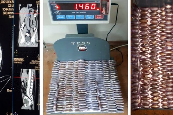 Midesinden 78 kapsül uyuşturucu çıktı