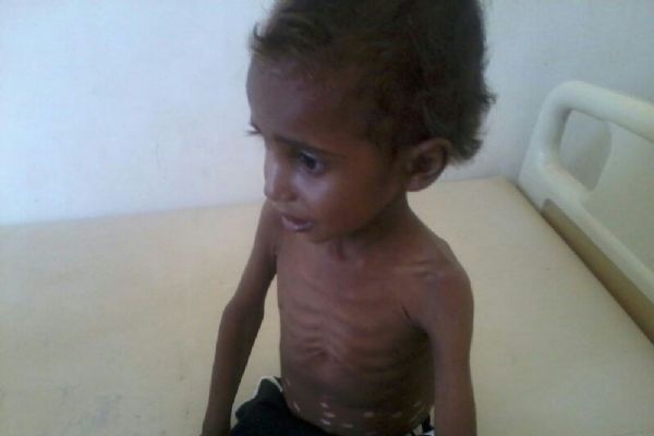 Yemenli çocukların yüzde 80'i insanı yardıma muhtaç