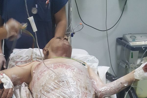 Samsun'da sigara içerken alevler içinde kaldı