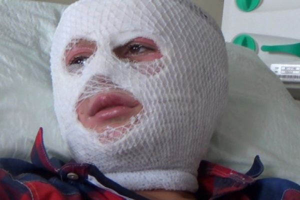 Erzurum'da patlayan parfüm şişesi yüzünü bu hale getirdi