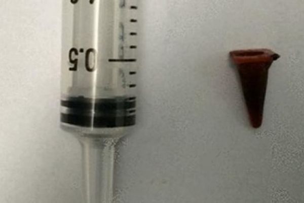 Çocukken ciğerine kaçan oyuncak 40 yıl sonra çıkardı