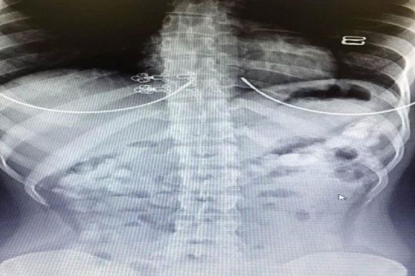 Antalya'da iç organlarını 5 bin dolar için uyuşturucuyla doldurmuş