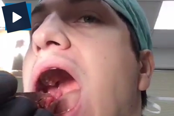 Kendi dişini kendi çekti!