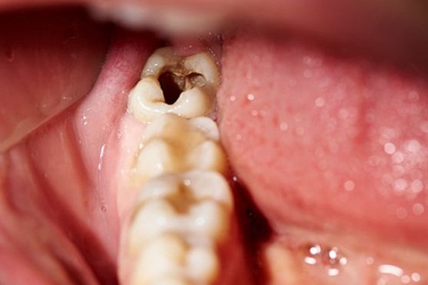 Kanıtlandı: Çürük dişleri yeniliyor