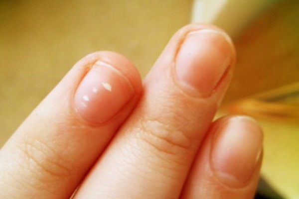 Tırnak beyazlaması nasıl önlenir?