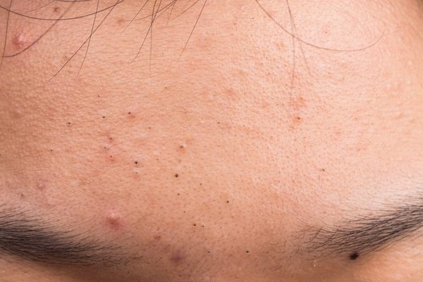 Siyah noktalara kahveli çözüm